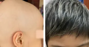 rụng tóc, hói đầu