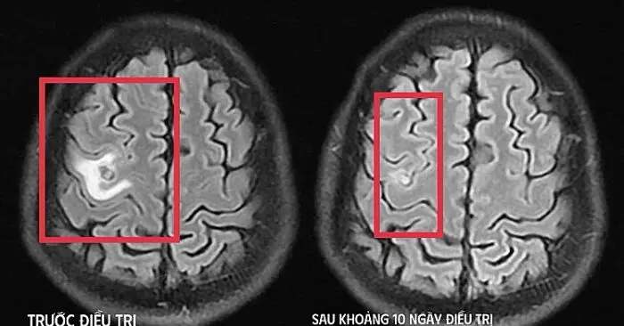 Sán làm tổ trong não khiến người đàn ông co giật