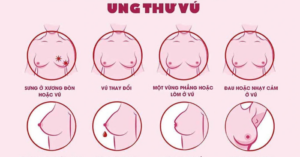 Ung thư vú: Bệnh ung thư phổ biến nhất ở phụ nữ Việt Nam