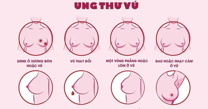 Ung thư vú: Bệnh ung thư phổ biến nhất ở phụ nữ Việt Nam