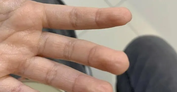 Bé gái ho kéo dài 2 năm: Manh mối từ thử nghiệm nhúng tay