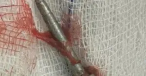 Nam thanh niên bị vật nhọn cắm sâu vào bụng