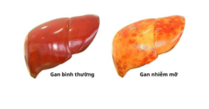 Nguy cơ mắc gan nhiễm mỡ ở người gầy do lối sống thiếu lành mạnh