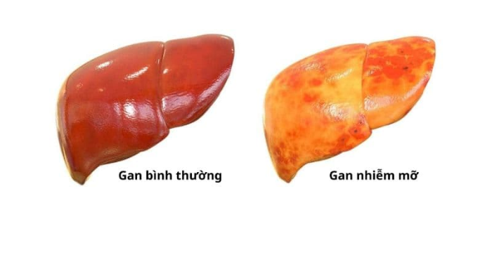 Nguy cơ mắc gan nhiễm mỡ ở người gầy do lối sống thiếu lành mạnh