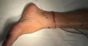 Nối bàn chân đứt lìa: Ca mổ cứu chân cho cụ ông ở Quảng Trị