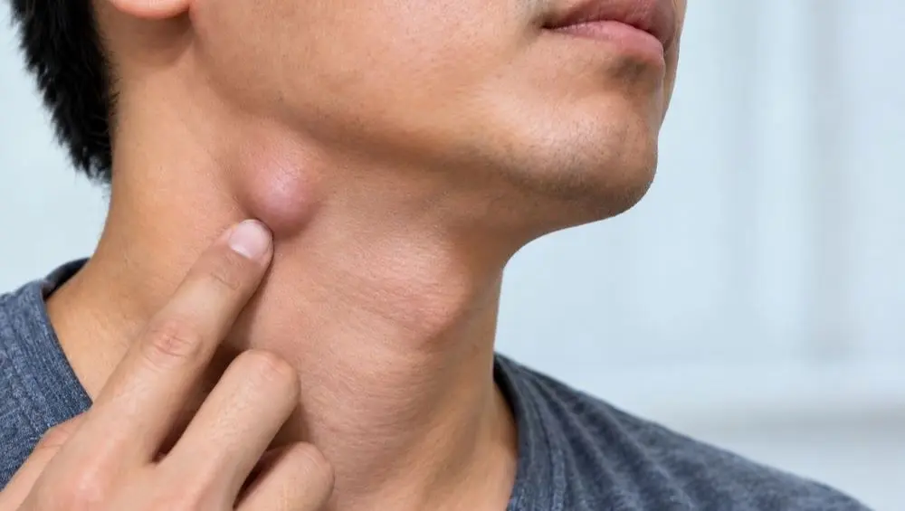 4 dấu hiệu cảnh báo hạch ở cổ là bất thường, giúp nhận biết khi nào tình trạng sưng hạch cần được lưu ý.