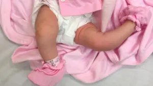 Bé sơ sinh chân “gập ngược” bất thường tại Bệnh viện Nhi Hải Phòng có sức khỏe cải thiện rõ rệt sau 8 ngày điều trị