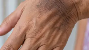 Tiền tiểu đường có thể khiến da sẫm màu bất thường. Nhận biết dấu hiệu gai đen và những cảnh báo đường huyết tiến triển xấu.