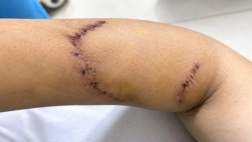 Nữ sinh lớp 9 ở Đắk Lắk bị bạn dùng dao tấn công gây thương tích. Vụ việc khiến dư luận quan tâm, đặt ra lo ngại về bạo lực học đường.